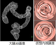CT コロノグラフィー