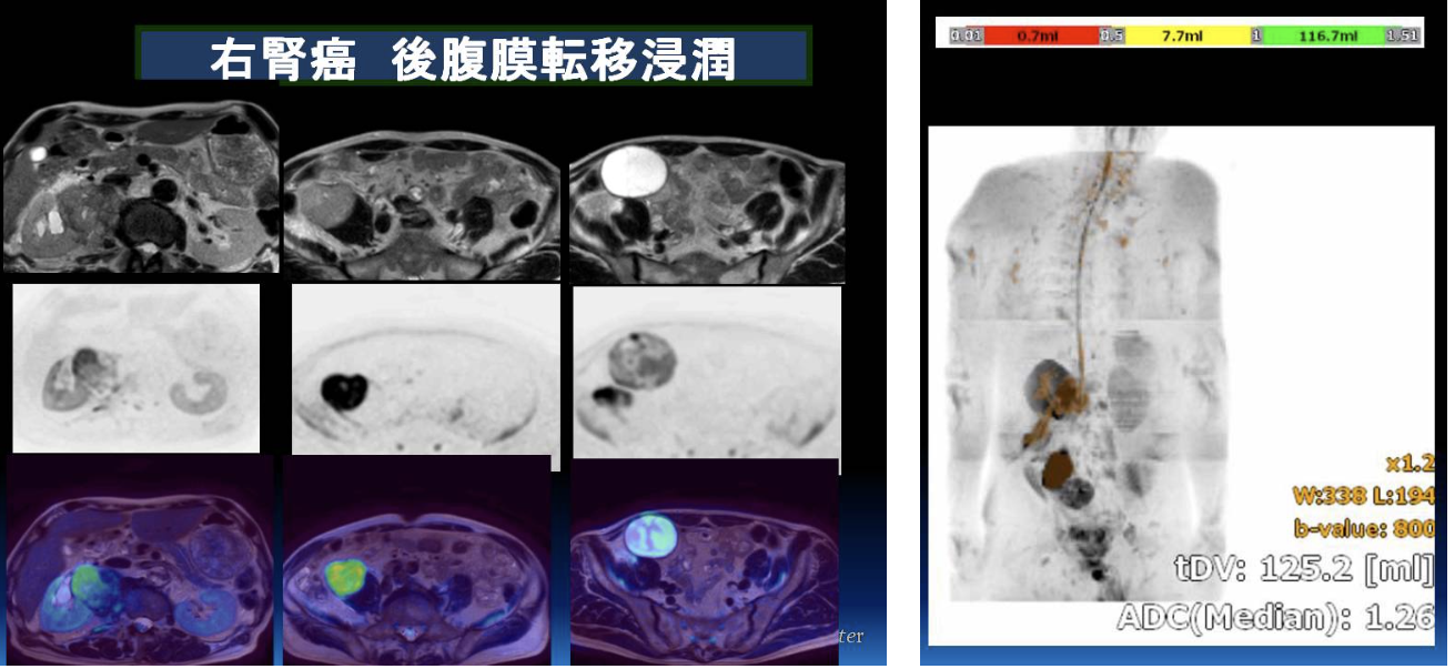 右腎癌の画像。MRIおよびPET/CTで後腹膜への転移浸潤が確認されている。複数断面の撮像と融合画像が並び、右腎腫瘍部が強調表示されている。