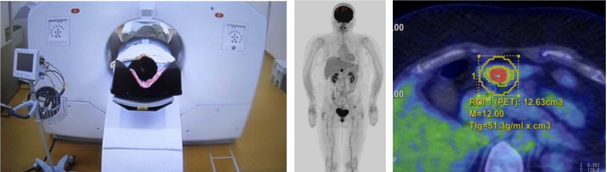 PET/CT検査の例。左にPET/CT装置、中央に全身PET画像、右に病変部のPET/CT融合画像。右画像では関心領域ROIが示され、体積と代謝値が表示されている。