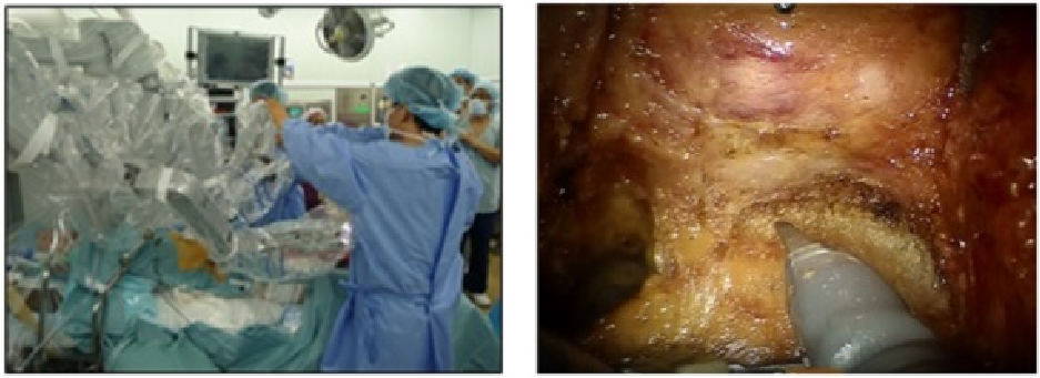 ロボット支援手術の様子。左は手術室でロボットアームを操作する医療スタッフ、右は術野映像でロボット鉗子により前立腺最深部から直腸を剥離している場面。