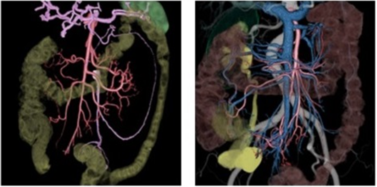 3D-CT再構成画像。大腸と周囲血管を立体表示し、綿密な手術計画による精緻なリンパ節郭清を可能にする様子を示している。