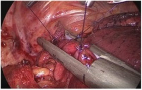 完全胸腔鏡下手術の術野。リニアステープラーを用いて食道と胃管を体腔内で吻合している場面。
