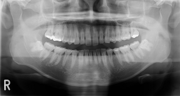 上下顎の歯と顎骨を含むオルソパントモグラフィ（パノラマX線撮影）の画像