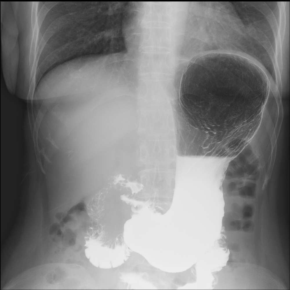胃バリウム（立位充満像）の写真