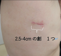 単孔式胸腔鏡手術後の創部２。